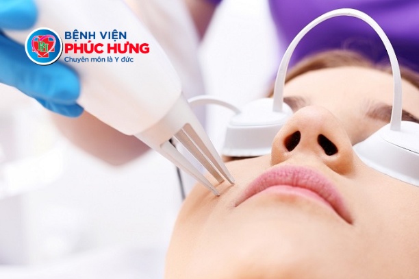 Điều trị Mụn cóc bằng công nghệ Laser ND-YAG