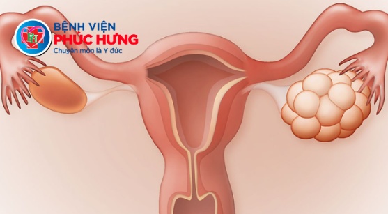 Phẫu thuật nội soi thành công khối u buồng trứng 