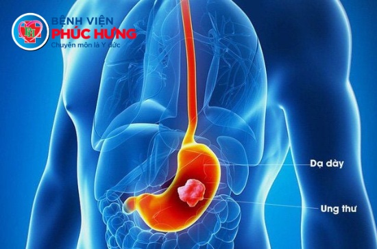 U Kruckenberg: Khi ung thư dạ dày 