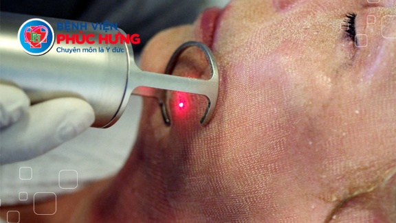 Điều trị sẹo rỗ bằng công nghệ Laser CO2 FRACTIONAL 