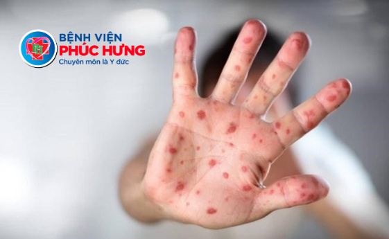 Dịch Tay Chân Miệng đang mùa cao điểm - Nhận biết sớm phòng ngừa kịp thời