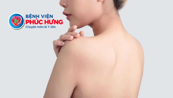 Mụn lưng - Nỗi tự ti khi hè sang