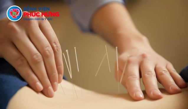 Kỹ thuật châm cứu giảm đau lưng, vai gáy hiệu quả tại Bệnh viện Phúc Hưng