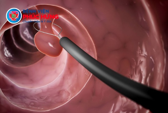Phát hiện và xử trí Polyp đại tràng khó bằng kỹ thuật EMR