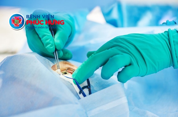 Không cần đi xa - Chuyên gia Mắt hàng đầu trực tiếp Phẫu thuật Phaco tại Phúc Hưng