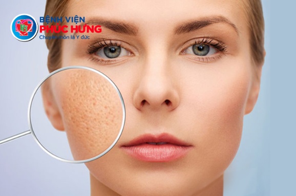 Lỗ chân lông to -Không phải 