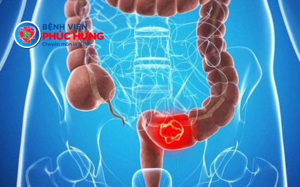 U thần kinh nội tiết trực tràng - Diễn biến thầm lặng nhưng có thể chữa khỏi nếu phát hiện sớm