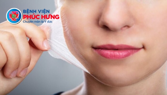 So sánh Peel da và Laser trong điều trị nám - Phương pháp nào phù hợp hơn?