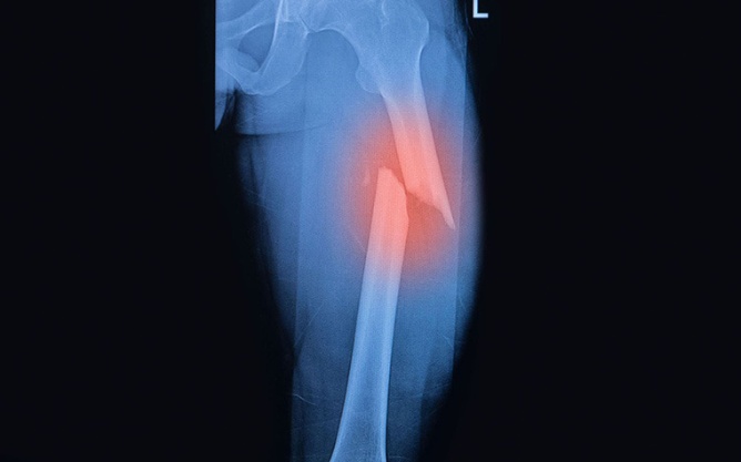 Phẫu thuật thành công ca gãy xương đùi nặng cho bệnh nhân 59 tuổi tại Bệnh viện Phúc Hưng