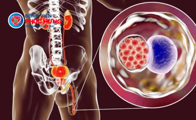 Nhận biết sớm viêm đường tiết niệu ở nam giới để tránh biến chứng nguy hiểm
