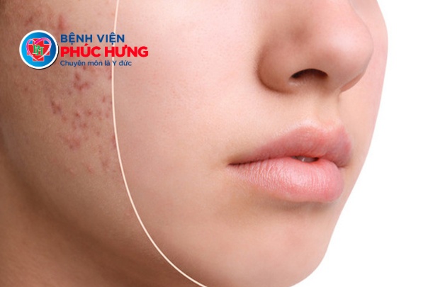 Top phương pháp điều trị sẹo rỗ hiệu quả - lấy lại làn da mịn màng