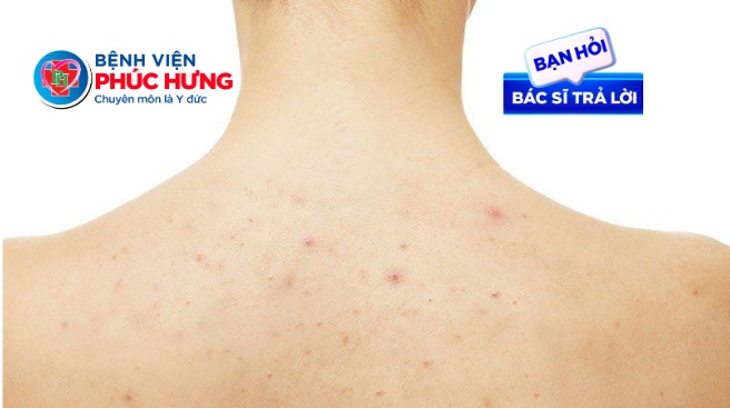 Da bị viêm nang lông có phải do vệ sinh kém không?