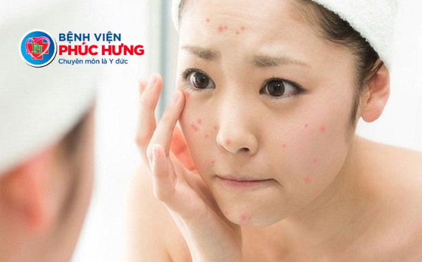 Mụn ở tuổi dậy thì có Peel da được không?