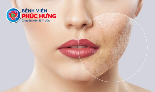 Điều trị sẹo lõm bằng phương pháp chấm TCA