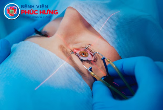 Phẫu thuật Phaco cùng chuyên gia nhãn khoa từ Bệnh viện Mắt TP.HCM
