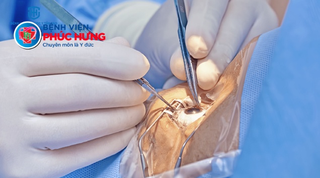 Đã được chẩn đoán đục thủy tinh thể, có cần thiết phải phẩu thuật ngay không?