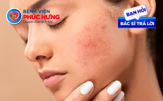 Đến mùa viêm da tiết bã - Cần lưu ý những gì?