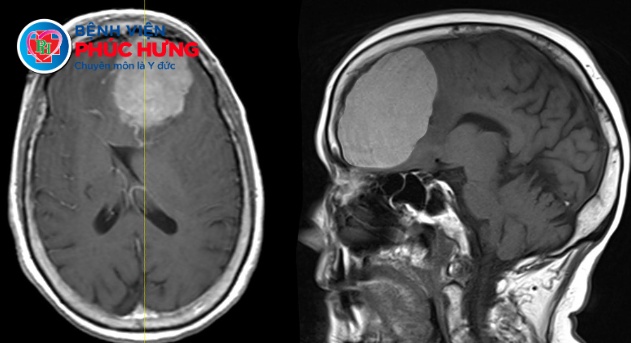 Điều trị thành công ca viêm màng não mũ nguy kịch - Cảnh báo từ triệu chứng sốt cao, lơ mơ, co giật