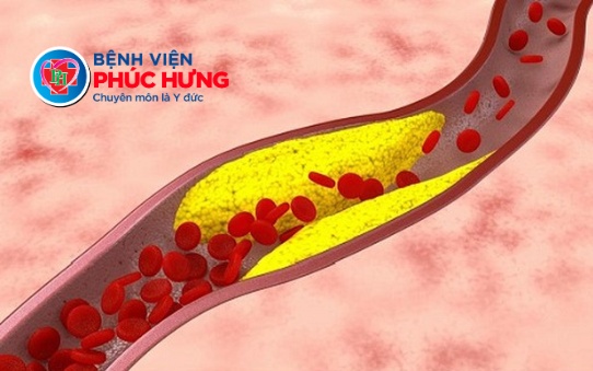 Cảnh báo: Nhiều bệnh mạch máu diễn biến âm thầm, khó nhận biết sớm