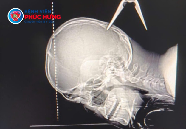Xử trí thành công ca chấn thương đầu nghiêm trọng do dị vật găm sâu 1,5cm