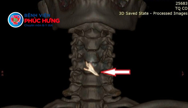 Xử lý cấp cứu dị vật thực quản: Tránh biến chứng nguy hiểm đến tính mạng