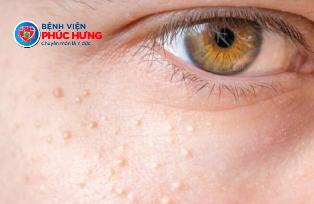 Mụn thịt - 