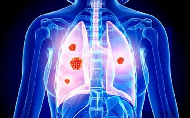 Thành công phẫu thuật nội soi cắt khí phổi hai bên cho bệnh nhân tại Bệnh Viện Phúc Hưng 