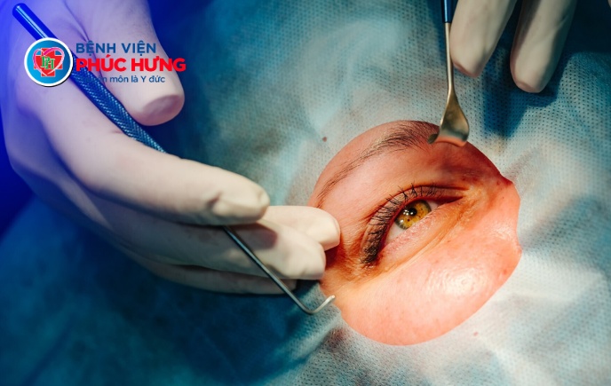 4 giai đoạn của đục thủy tinh thể mà người bệnh cần phải biết