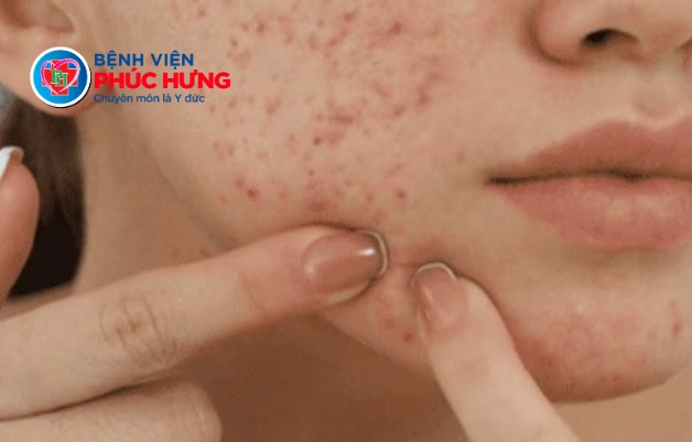 Dừng lại ngay nếu bạn đang tự nặn mụn tại nhà!