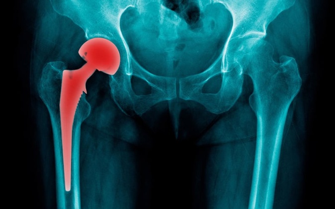 Phẫu thuật thay khớp háng thành công cho bệnh nhân bị ung thư phổi