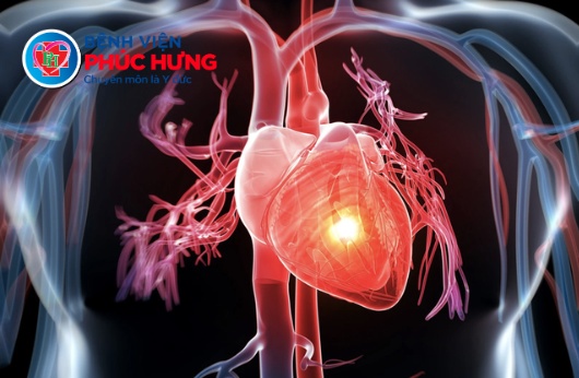 Cấp cứu thành công ca rối loạn nhịp tim nặng nguy kịch trên nền bệnh mạch vành mạn