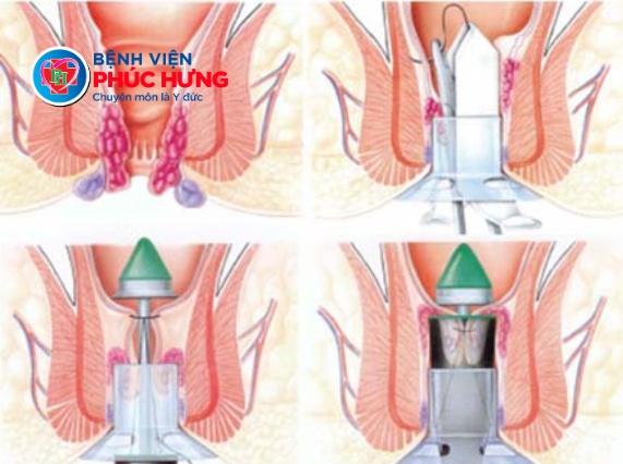 Không còn ám ảnh bệnh trĩ - Giải pháp ít đau, phục hồi nhanh với phẫu thuật Longo