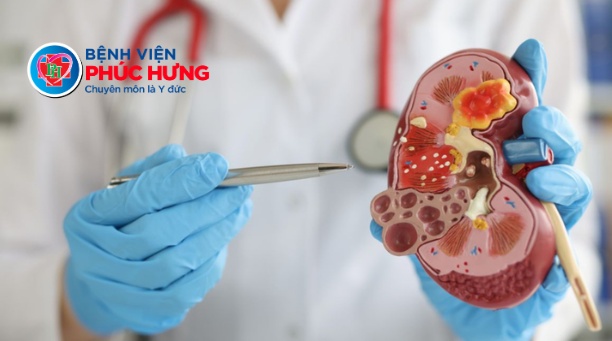 Hiệu quả cao của phẫu thuật tán sỏi thận qua da tại Bệnh viện Phúc Hưng