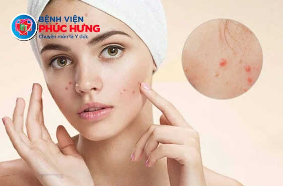 Khi nào nên đến bác sĩ da liễu thay vì tự mua mỹ phẩm trị mụn?