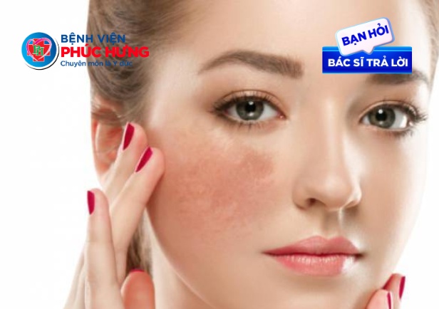 Điều trị nám sau một liệu trình thì có hết hẳn không?