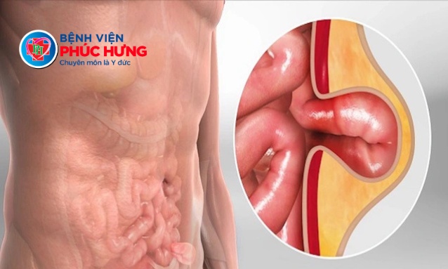 Thoát vị bẹn – Khi nào cần can thiệp?