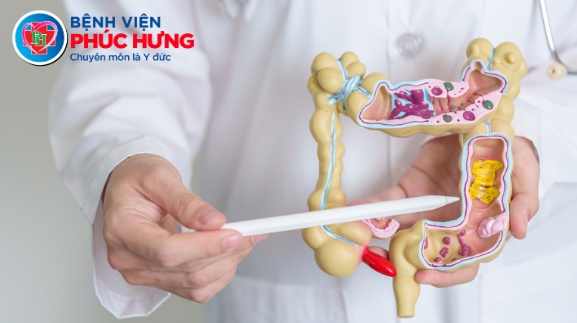 Phát hiện polyp đại tràng tiền ung thư nhờ Nội soi tầm soát Ung thư tiêu hóa
