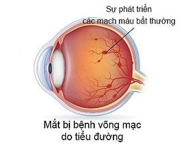 TẦM SOÁT BỆNH VÕNG MẠC ĐÁI ĐƯỜNG - SOI ĐÁY MẮT