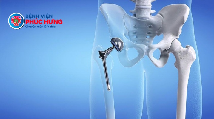 Phẫu thuật liên mấu chuyển xương đùi bằng PFNA tại Bệnh viện Phúc Hưng