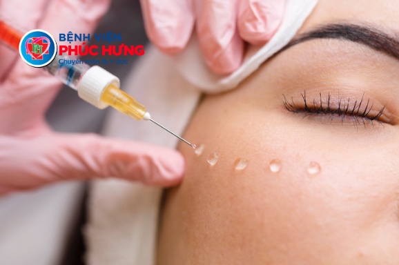 Mesotherapy - Giải pháp hỗ trợ làn da sau lạm dụng CORTICOID