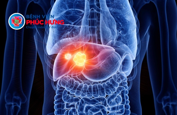 Ung thư gan - Dấu hiệu nhận biết sớm và cách phòng tránh hiệu quả