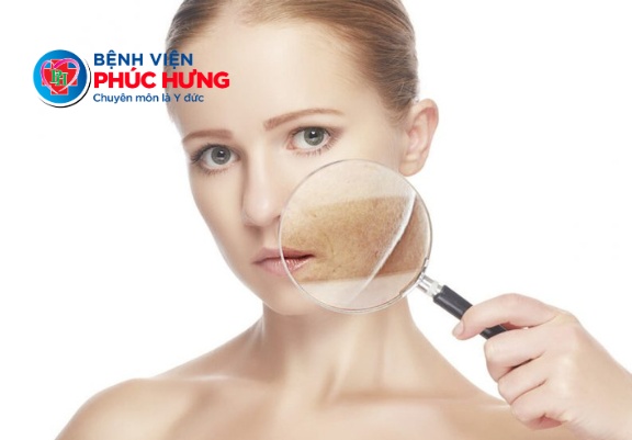Phân biệt 3 loại nám da phổ biến - Hiểu đúng để chăm sóc đúng
