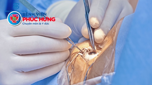 Triển khai chương trình hỗ trợ phẫu thuật đục thủy tinh thể (PHACO) miễn phí cùng chuyên gia